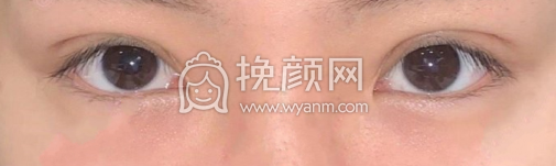 合肥蝶之星整形李树平全切双眼皮案例|果|价格