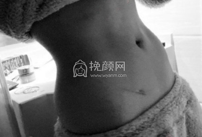杭州新清吟冀宇腰腹环吸+妈妈臀案例|果|价格