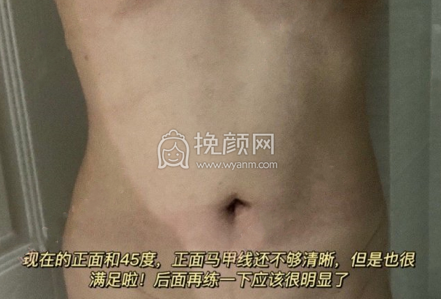 杭州新清吟冀宇腰腹环吸+妈妈臀案例|果|价格