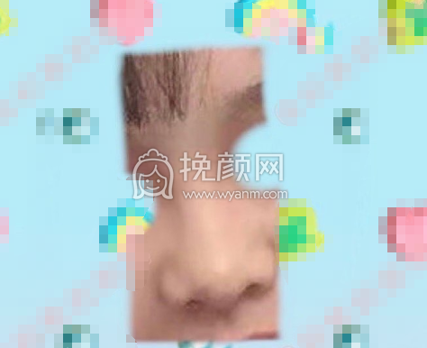 武汉协和医院钟爱梅耳软骨鼻部手术案例|果|价格