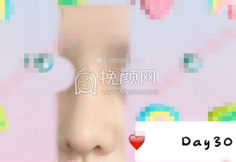 武汉协和医院钟爱梅耳软骨鼻部手术案例|果|价格