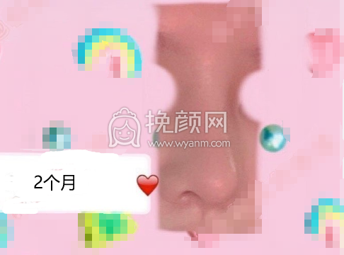 武汉协和医院钟爱梅耳软骨鼻部手术案例|果|价格