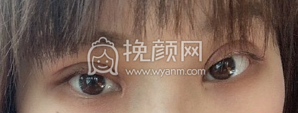 医颜医疗门诊李华全切双眼皮修复park法案例|果