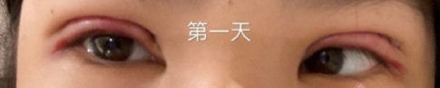 厦门大学附属第一医院殷佳鹏切开双眼皮案例|