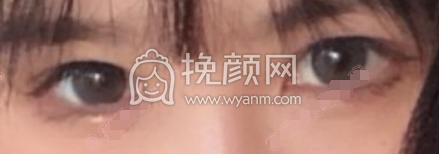 厦门大学附属第一医院殷佳鹏切开双眼皮案例|