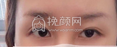 长沙颜华美容俞惠忠医生全切双眼皮修案例|果