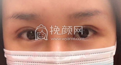 长沙颜华美容俞惠忠医生全切双眼皮修案例|果