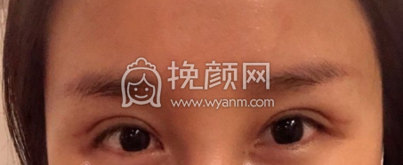 长沙颜华美容俞惠忠医生全切双眼皮修案例|果