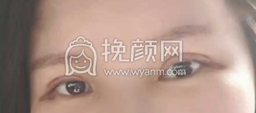 汕头第一附属医院找任帅医生全切双眼皮案例|