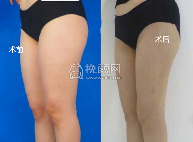 八大处陈博大腿环吸+自体脂肪填胸案例|果|价