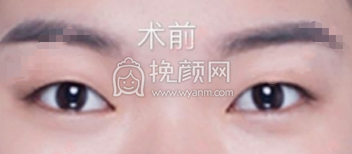 厦门市新开元医院殷佳鹏医生全切双眼皮案例|