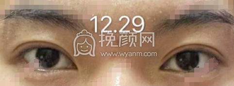 厦门市新开元医院殷佳鹏医生全切双眼皮案例|