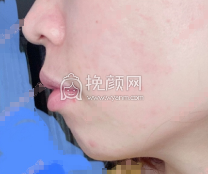  长沙陈铁夫医生硅胶假体垫下巴案例|果|价格