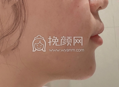  长沙陈铁夫医生硅胶假体垫下巴案例|果|价格