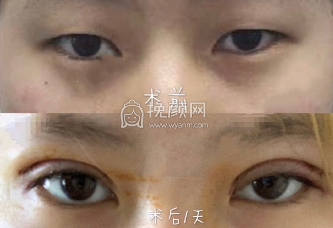 上海九院范海燕全切双眼皮手术案例|果|价格