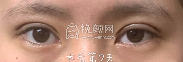 上海九院范海燕全切双眼皮手术案例|果|价格