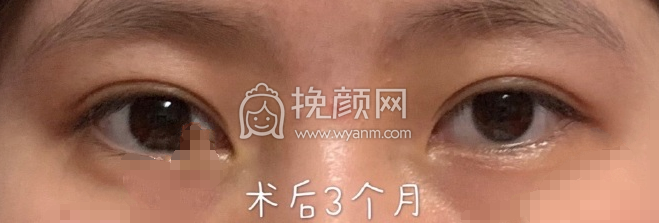 上海九院范海燕全切双眼皮手术案例|果|价格