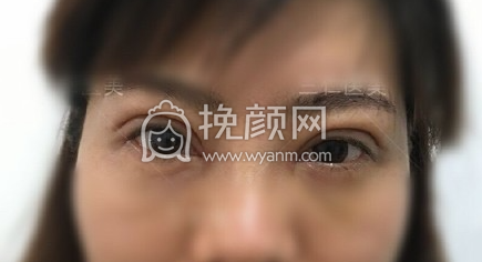 北京三仁医院伊光全切双眼皮去皮去脂案例|果