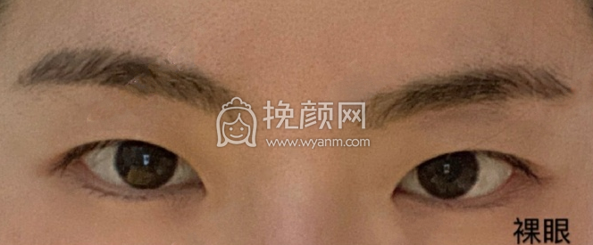沈阳杏林整形医院房红超医生全切双眼皮案例|