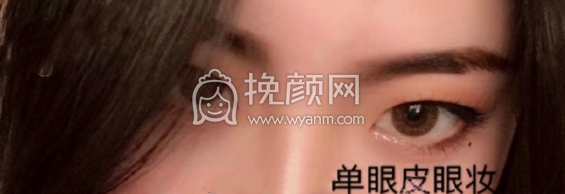 沈阳杏林整形医院房红超医生全切双眼皮案例|