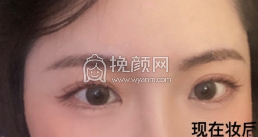 沈阳杏林整形医院房红超医生全切双眼皮案例|