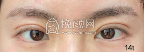 沈阳杏林整形医院房红超医生全切双眼皮案例|