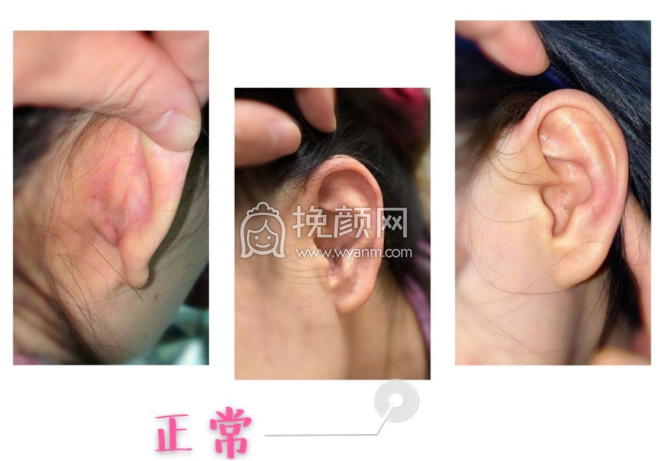 武汉协和整形钟爱梅医生做耳软骨隆鼻果怎么
