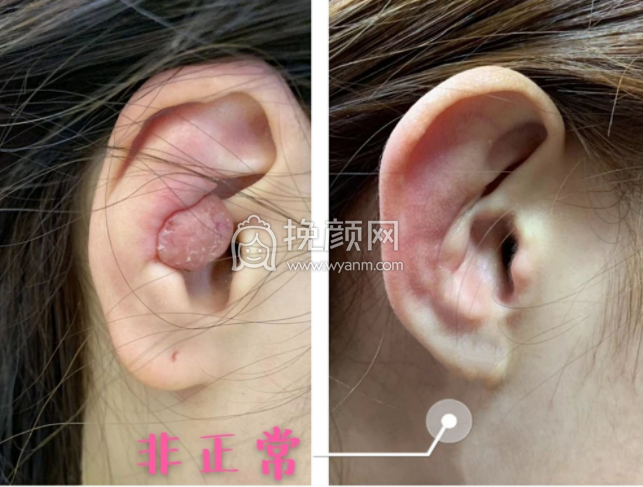 武汉协和整形钟爱梅医生做耳软骨隆鼻果怎么