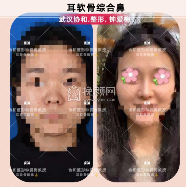 武汉协和整形钟爱梅医生做耳软骨隆鼻果怎么
