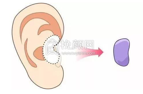 武汉协和整形钟爱梅医生做耳软骨隆鼻果怎么