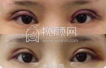 上海九院眼科胡海林医生双眼皮修复案例|果