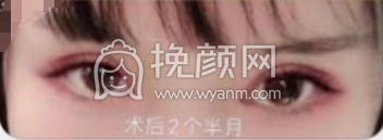 上海九院眼科胡海林医生双眼皮修复案例|果