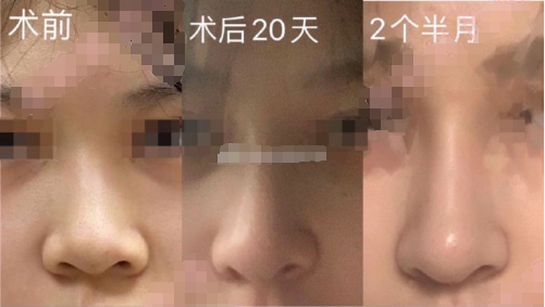 武汉协和医院钟爱梅医生耳软骨鼻部手术+缩鼻翼案