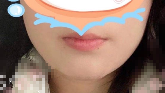 上海九院张路医生假体垫下巴案例|价格|果