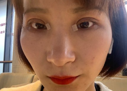 上海申德医院周一雄医生全切双眼皮案例|果