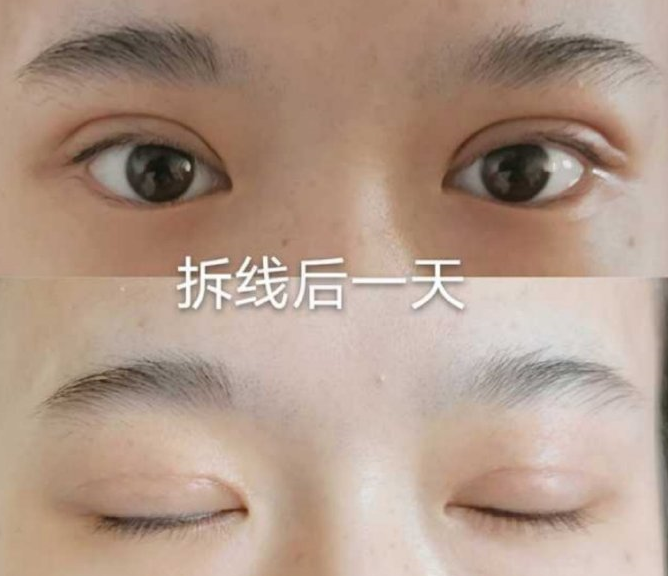 上海九院金锐医生全切双眼皮去皮去脂案例|果