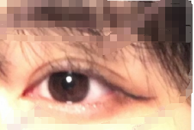 武汉思美颜孔伟医生三点埋线双眼皮手术案例|