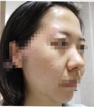 上海九院盛玲玲医生面部吸脂(面颊+下颌缘吸脂