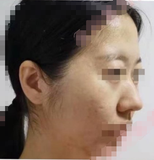 上海九院盛玲玲医生面部吸脂(面颊+下颌缘吸脂