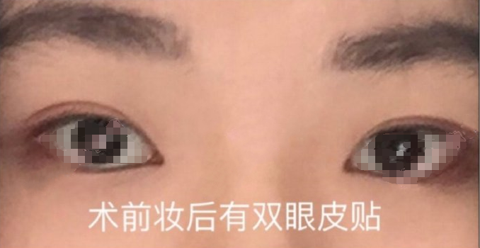 上海九院李华医生双眼皮全切去皮案例|果|价格