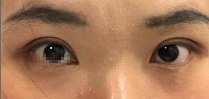 上海九院李华医生双眼皮全切去皮案例|果|价格