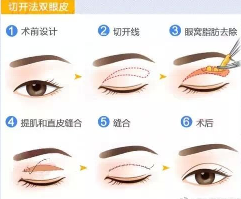 为什么要选择做全切双眼皮手术?
