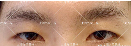 上海九院王梓做全切双眼皮技术怎么样?