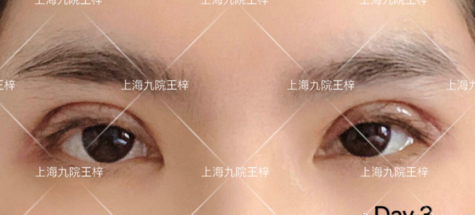 上海九院王梓做全切双眼皮技术怎么样?