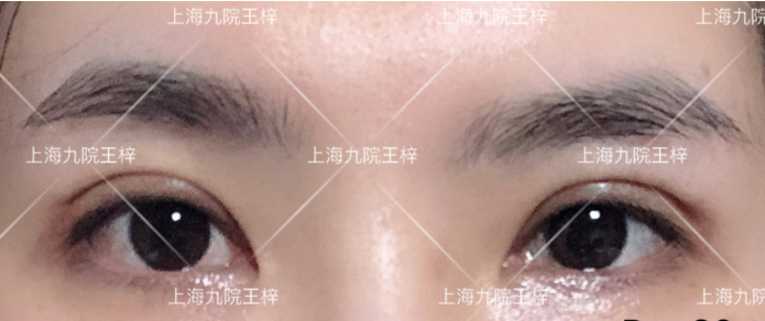 上海九院王梓做全切双眼皮技术怎么样?