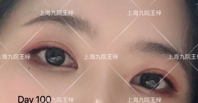 上海九院王梓做全切双眼皮技术怎么样?