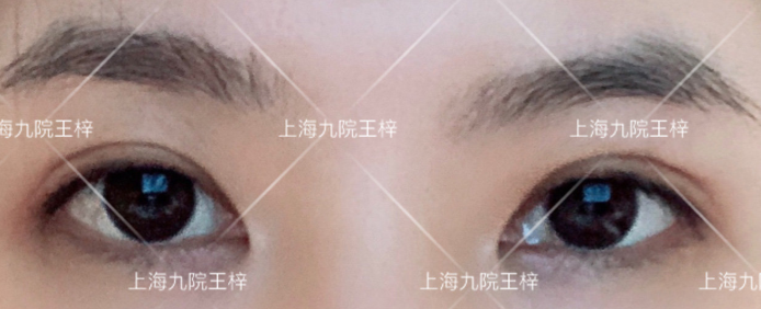 上海九院王梓做全切双眼皮技术怎么样?