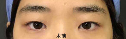 想知道我的双眼皮需不需要修复?