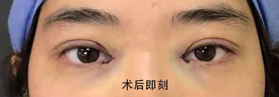 想知道我的双眼皮需不需要修复?