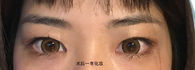 想知道我的双眼皮需不需要修复?